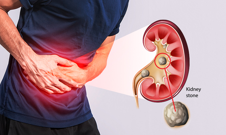 Typhoid vs Tuberculosis: Know the Difference